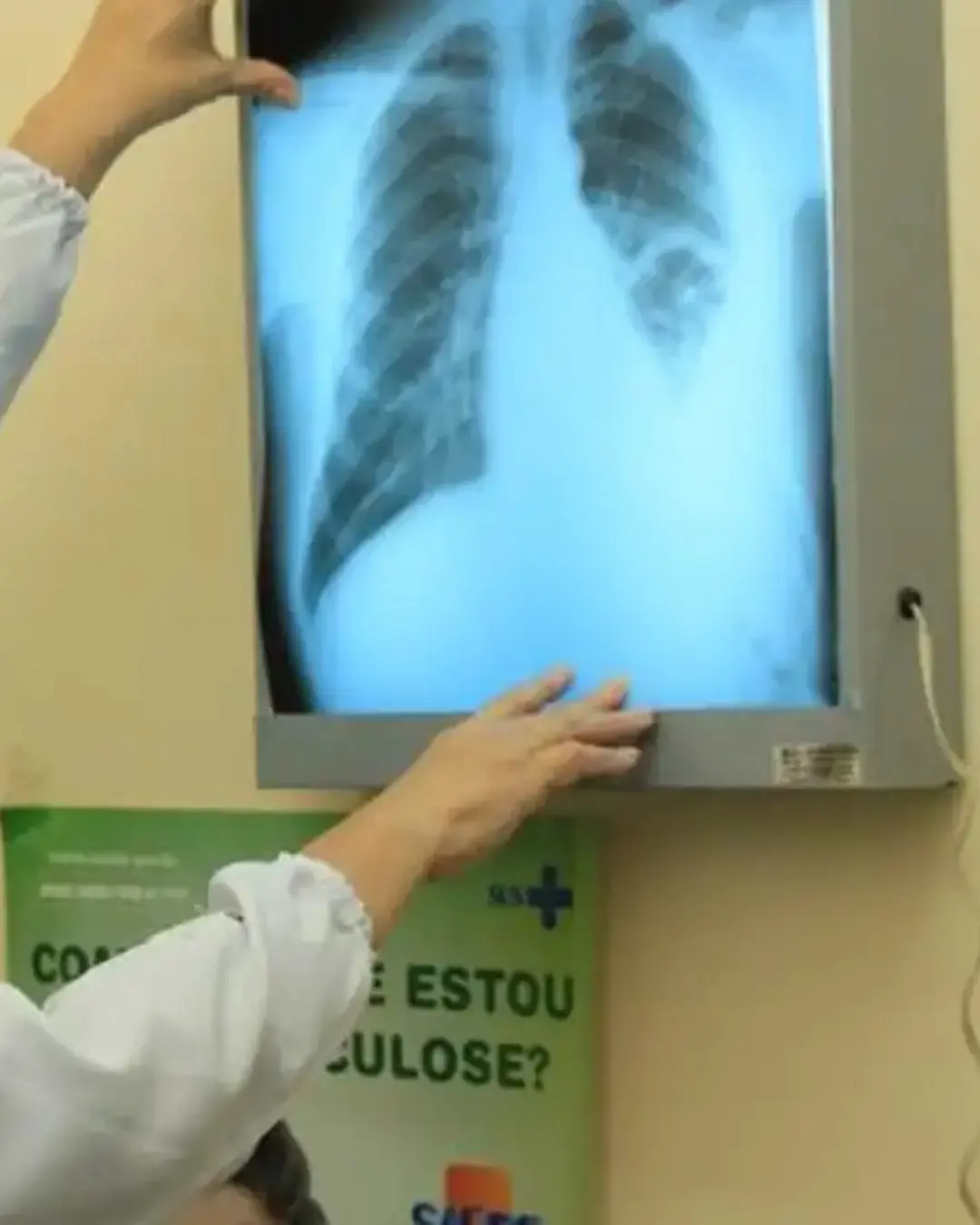 Brasil enfrenta piora na incidência de tuberculose, contrariando metas da OMS para 2030